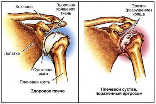 Показания к эндопротезированию плечевого сустава