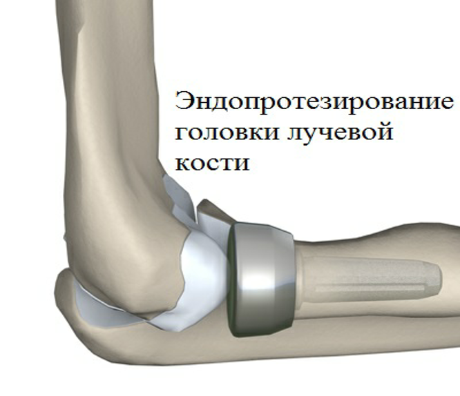 Фото эндопротезирования головки лучевой кости